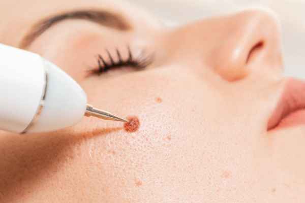 CryoPen: 5 Skin Concerns It May Be Used to Treat 3 What actually happens during a CryoPen treatment Grays?