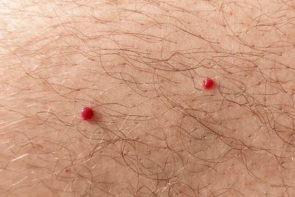 CryoPen: 5 Skin Concerns It May Be Used to Treat 2 cherry angioma removal Grays