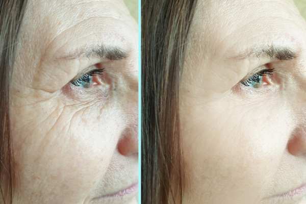 Why Do People Choose HIFU for a Non-Surgical Facelift? 4 How long can HIFU results last Grays?