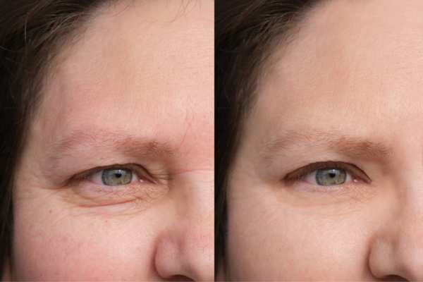 HIFU vs Botulinum Toxin: Understanding the Differences 4 How long do HIFU results last Grays?
