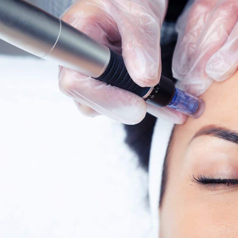 Morpheus8 treatment Grays from Lipo Sculpt - Book in today!