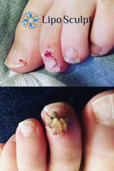 Wart removal customer results from Lipo Sculpt Grays